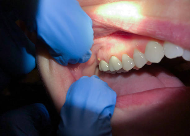 Best Emergency Tooth Extraction in Mcalmont, AR
